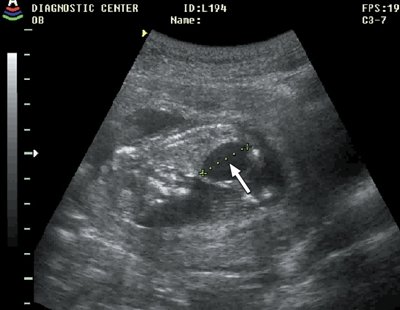 Мегацистис (стрелка), беременность 11 недель 3 дня