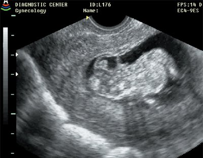Иниоэнцефалия, беременность 11 недель 6 дней