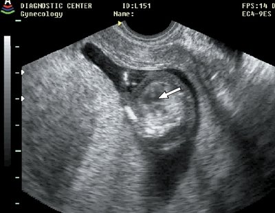 Дефект межжелудочковой перегородки (стрелка), беременность 12 недель