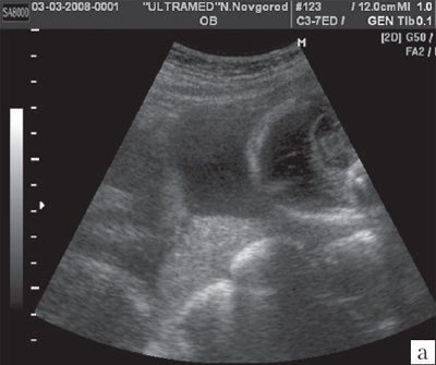 Беременность 24-25 недель - трансабдоминальное сканирование области внутреннего зева в продольном направлении (В-режим)