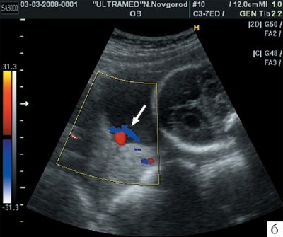 Беременность 24-25 недель - трансабдоминальное сканирование области внутреннего зева в продольном направлении (режим ЦДК)