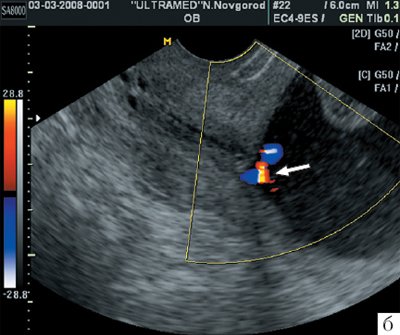 Беременность 24-25 недель - трансвагинальное сканирование области внутреннего зева в продольном направлении (режим ЦДК)