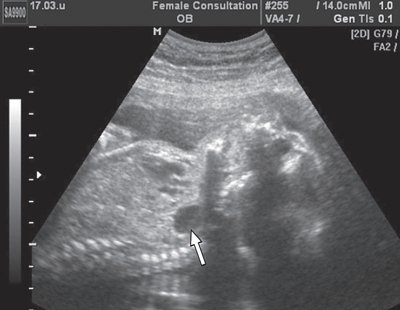 Эхограмма продольного сечения грудной клетки плода - стрелкой указан желудок плода, расположенный в его грудной клетке