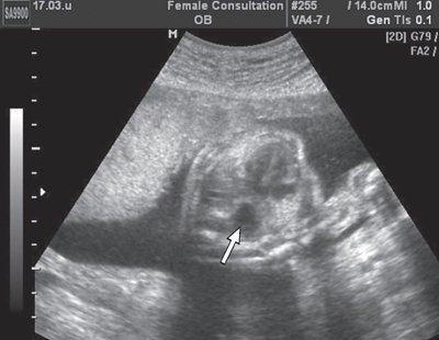 Эхограмма поперечного сечения грудной клетки плода - стрелкой указан желудок плода, расположенный в его грудной клетке