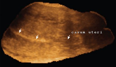Нормальная 3D-эхограмма матки после самопроизвольных родов