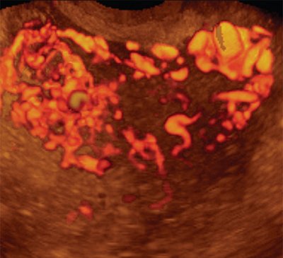 Трехмерная допплерограмма при субинволюции матки на 4-е сутки после самопроизвольных родов