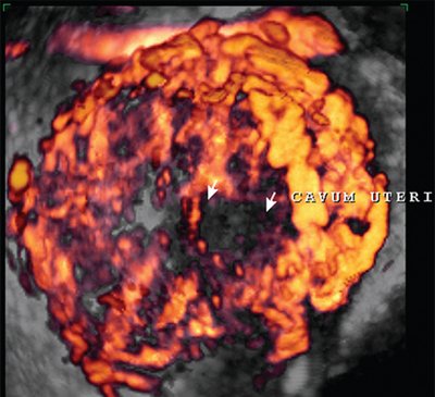 Повышенная васкуляризация матки в режиме трехмерной энергетической допплерографии у родильницы с гематолохиометрой на 4-е сутки после самопроизвольных родов