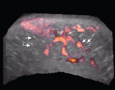 Нормальная 3D-допплерограмма шва на матке после кесарева сечения (1, 2 - сосуды нижнего маточного сегмента)