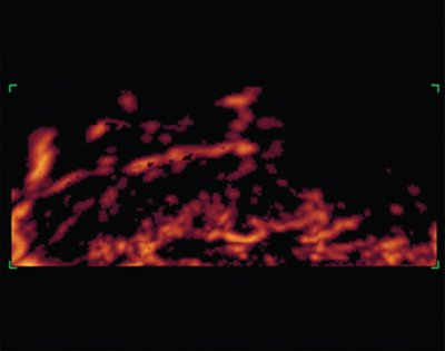 Трехмерная энергетическая допплерограмма области шва на матке после кесарева сечения на 6-е сутки послеродового периода у родильницы с субинволюцией матки