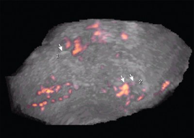 Сниженная васкуляризация шва на матке в режиме трехмерной энергетической допплерографии при эндометрите после кесарева сечения