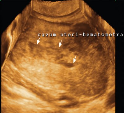Трехмерная эхограмма матки при гематолохиометре после самопроизвольных родов
