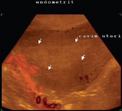 Трехмерная эхограмма матки при послеродовом эндометрите после кесарева сечения