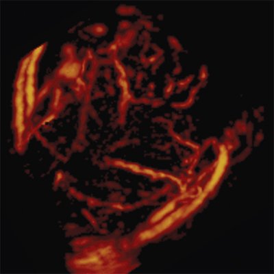 Нормальная 3D-допплерограмма матки на 4-е сутки после самопроизвольных родов