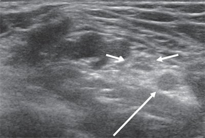 Срединный нерв на уровне локтевого сустава в поперечной проекции, рядом визуализируется плечевая артерия