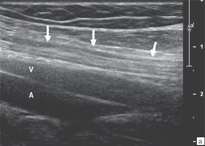 Продольная сонограмма большеберцового нерва в подколенной ямке, визуализируется подколенный сосудистый пучок - вена и артерия