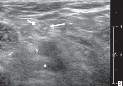 Поперечная сонограмма большеберцового нерва в подколенной ямке, визуализируется подколенный сосудистый пучок - вена и артерия