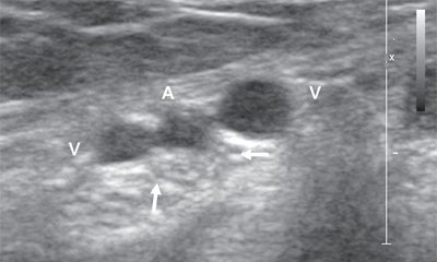 Поперечная сонограмма большеберцового нерва на уровне медиальной лодыжки, визуализируются заднебольшеберцовые вены и артерия