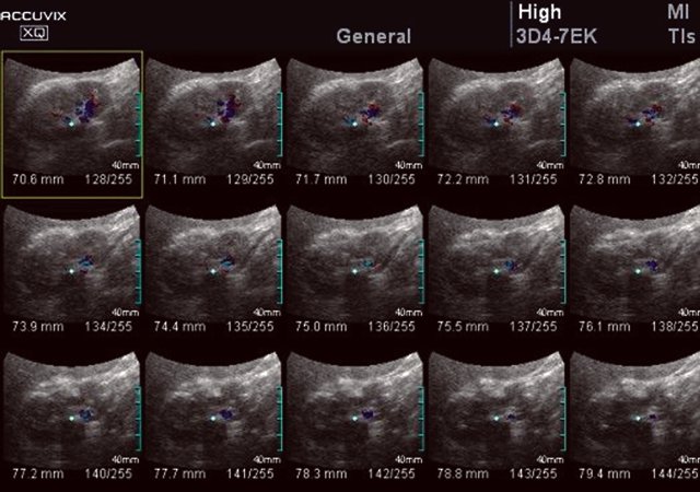 УЗИ почки (технология MultiSliceView) - на послойных срезах определяются точные размеры очага склероза