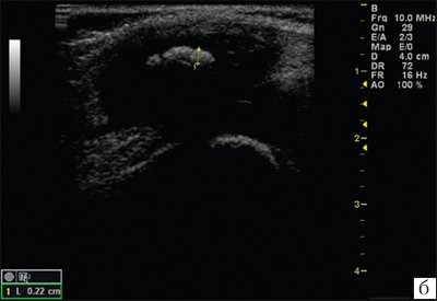 Эхограмма коленного сустава - начальные проявления ювенильного ревматоидного артрита