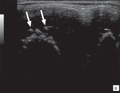 Ювенильный ревматоидный артрит - хрящевая ткань в виде древообразных разрастаний