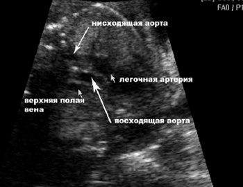 Аксиальное сечение грудной клетки плода на уровне отхождения основных сосудов