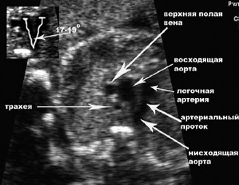 Правая аберрантная артерия. Общий артериальный ствол ЭХОКГ. Боталлов проток на ЭХОКГ. Персистирующая верхняя полая Вена УЗИ. Транспозиция магистральных сосудов ЭХОКГ.