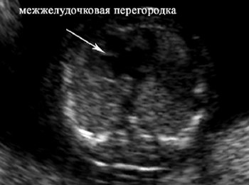 Четырехкамерный срез сердца плода в 13 нед 6 дней