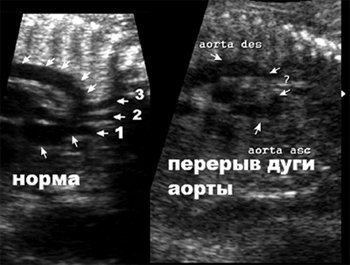 Дуга аорты в норме и при ее перерыве, срез через дугу аорты, ветви дуги аорты: 1- брахиоцефальный ствол, 2 - левая сонная, 3 - левая подключичная артерии