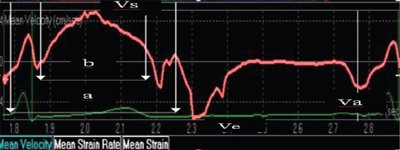 ТДИ. Принцип расчета по программе Q-lab ШРИ6аз, индекса Tei, график средней скорости движения миокарда в базальном сегменте перегородки, индекс Tei = (a-b/b)