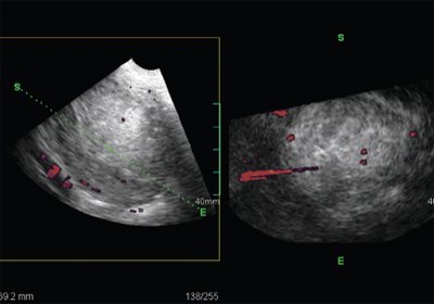 ТВУЗИ, режим энергетического картирования, УЗИ, выполненное с применением технологии Oblique view, 3D объемные данные позволяют уточнить состояние эндометрия и характер эндометриальной и субэндометриальной васкуляризации