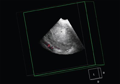 Режим многоплановой реконструкции, Volume CT view, 3D данные позволяют максимально точно определять объемы