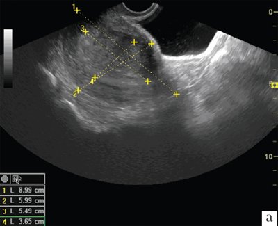 ТВУЗИ, В-режим, продольное сканирование, рак эндометрия Ib стадии, определение индекса эндометриальной инвазии
