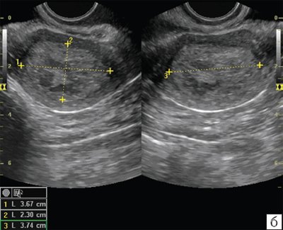 ТВУЗИ, В-режим, поперечное сканирование, рак эндометрия Ib стадии, определение индекса эндометриальной инвазии