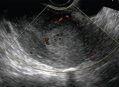 ТВУЗИ, ЦДК, продольное сканирование, рак эндометрия Iа стадии, инфильтративное образование гиперэхогенной структуры в области дна тела матки с пониженной васкуляризацией