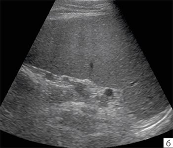 Эхограмма селезенки ребенка с циррозом печени в исходе хронического гепатита В, стрелкой указан один из циллотических узлов
