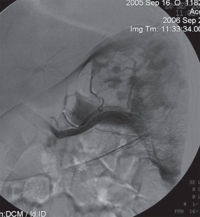 Ангиограмма селезенки после ее повторной окклюзии у больного гемолитической анемией