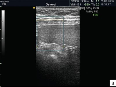 УЗИ селезенки в обычном режиме