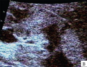 пациент 5 лет, острый пиелонефрит, признаки интраренального тубуло интерстициального рефлюкса в виде формирующейся апостемы