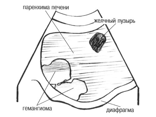 Схема - паренхима печени, желчный пузырь, гемангиома и диафрагма