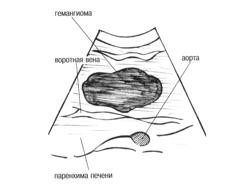 Схема - гемангиома, воротная вена, аорта и паренхима печени