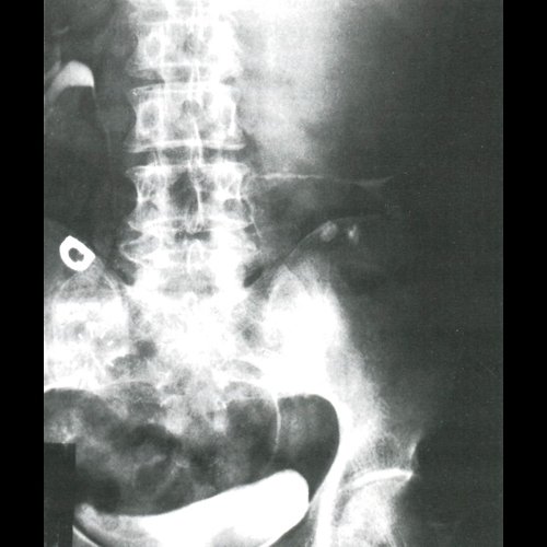 Рентгенограмма - эхинококковая киста левой почки