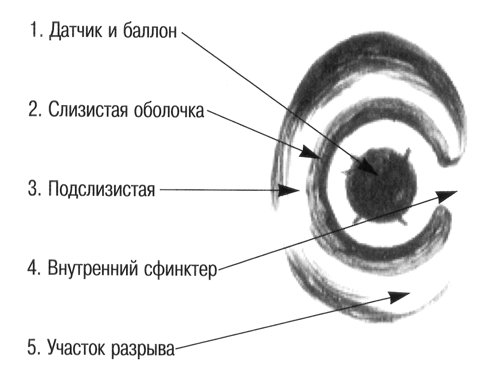 Схема - внутренний сфинктер