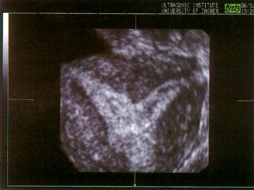 Изображение матки с перегородкой во фронтальной плоскости