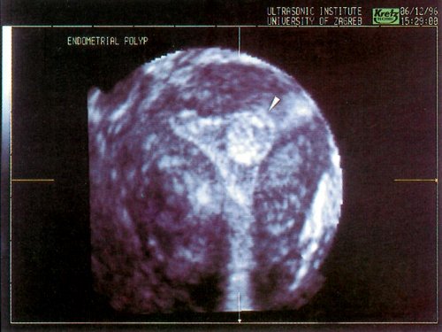 Эхограмма - матка во фронтальной плоскости, стрелка указывает на полип эндометрия