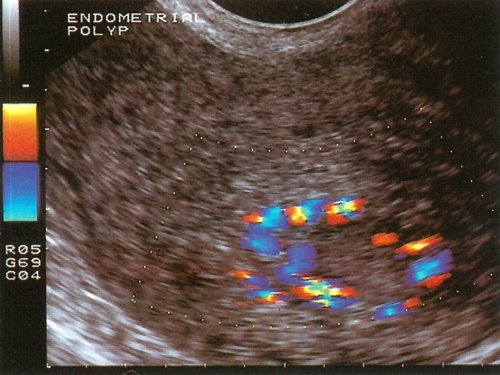 ТВУЗИ матки - васкуляризированный полип эндометрия (цветной допплер)