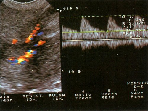 ТВУЗИ матки - полипа эндометрия (цветной и импульсный допплер)