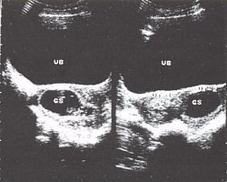 Эхограмма - беременность в двурогой матке