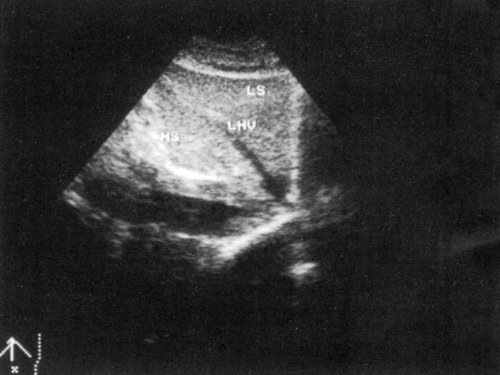 Эхограмма - медиальный и латеральный сегменты левой доли печени