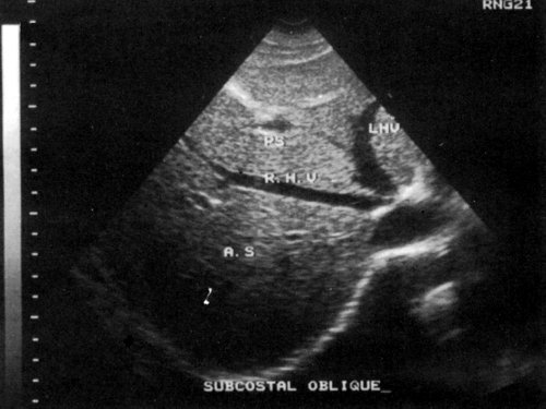 Эхограмма - изображение печеночных вен (норма)