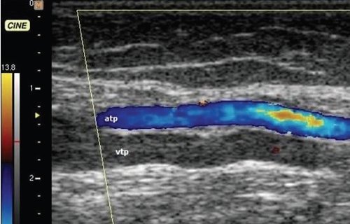 Эходопплерограмма большеберцового сосудистого пучка